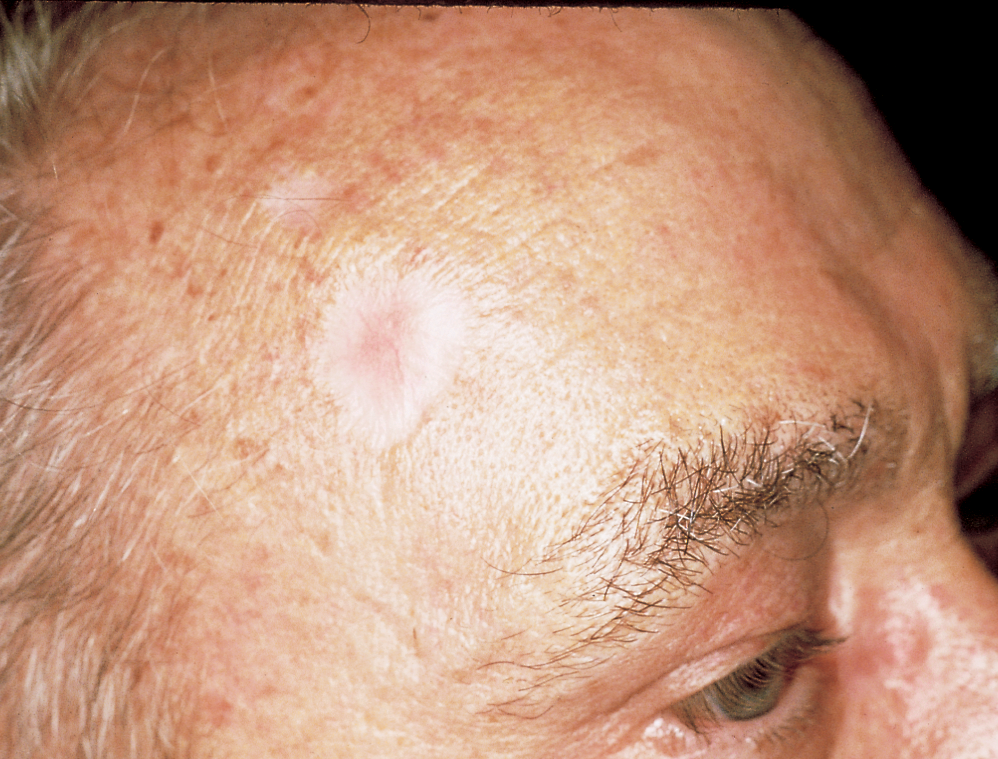 The Most Common Skin Cancer: Basal Cell Carcinoma