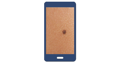 Send us a picture of your skin lesion